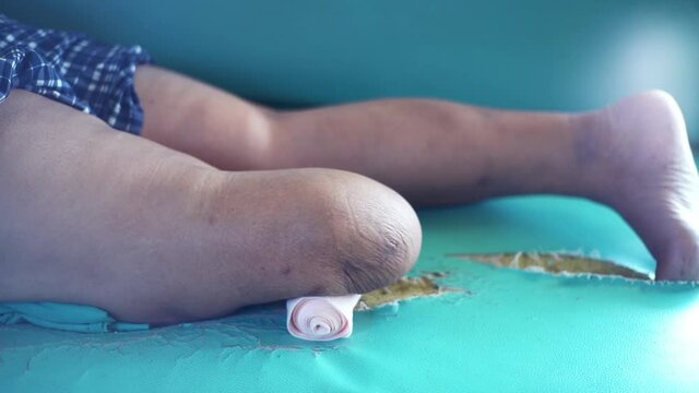 below knee amputee muscle training footage for BK prosthesis