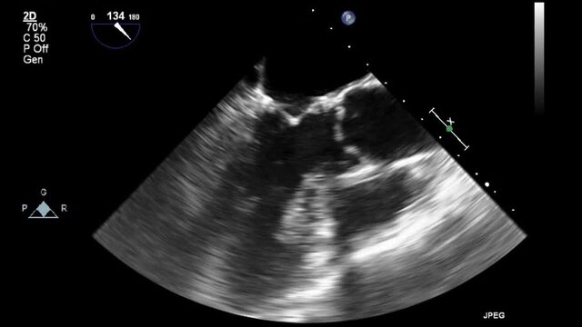 Transesophageal ultrasound video in gray-scale mode.