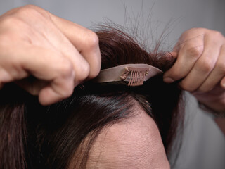 Applying a hair topper on top of a woman's natural hair and scalp. Covering hair thinning on the...