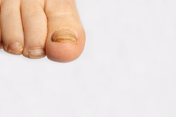 Fungus of nails on the big toe - dermatomycosis and onychomycosis, fungal infection macro photo....