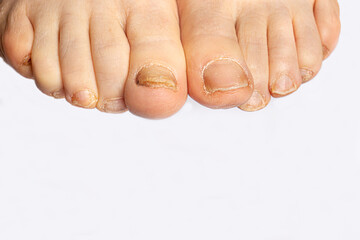 Foot nail fungus - a comparison of healthy and sore feet. Dermatomicosis and onyhomicosis, fungal...