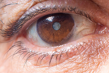 Macro photos of the human eye - cataract clouding of the lens, deterioration of vision. Treatment,...