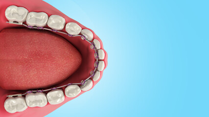 Lingual braces system on a demonstration denture 3d on blue gradient