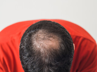 Fighting hair loss in men. Baldness, man worried about hair loss