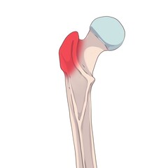 Greater trochanter . The femur, or thigh bone, is the proximal bone of the hindlimb in tetrapod vertebrate, the largest bone of the human body. 