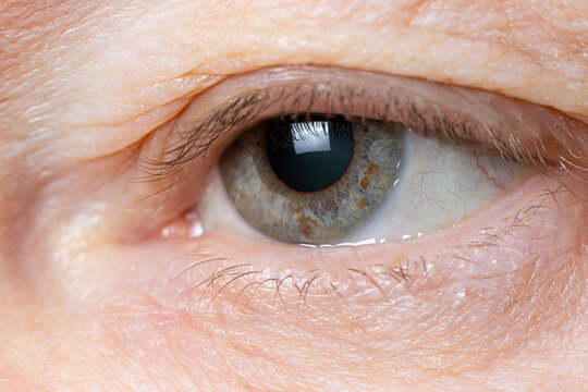 Macro photo of the human eye - overhanging upper eyelid, omitted eyelid ptosis, tired look of the old man, insomnia.