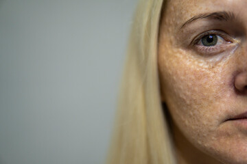 Woman's face after mesotherapy injections. beauty injections