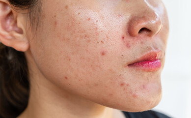 Cropped shot of woman having problems of acne inflamed on her face. Inflamed acne consists of...
