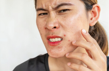 Asian woman having painful from acne inflamed on her face. Inflamed acne consists of swelling,...