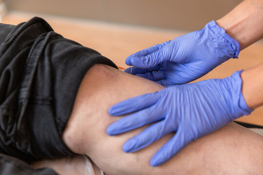 physiotherapist giving treatment with dry needling to patient
