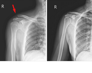 X-ray Right Shoulder Subluation of Rt.Acromioclavicular joint(AC) injury and Normal joint ,Moderate swelling of soft tissue.Medical image concept.