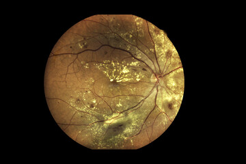 View inside human eye disorders showing retina, optic nerve and macula Severe age-related macular...