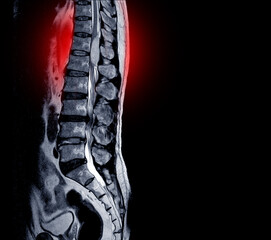 MRI scan of lumbar spines of a patient finding Spinal mass at Lt.side T12-L1 level Severe bulging...