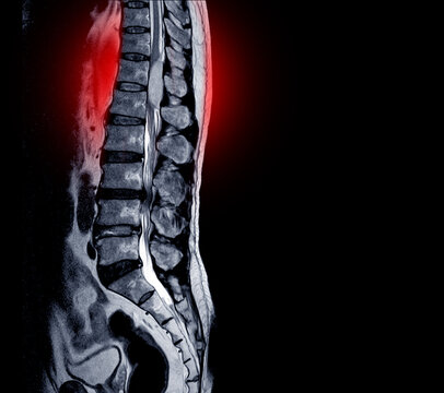 MRI scan of lumbar spines of a patient finding Spinal mass at Lt.side T12-L1 level Severe bulging disc L3-4 causing bilateral L4 nerve root compression  and spinal stenosis on red point.