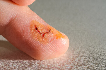 Doctor treats a wound on a finger with an iodine antiseptic