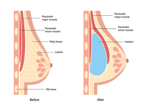 Breast Implant Concept