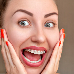Closeup Braces on Teeth. Woman Smile with Orthodontic Braces.