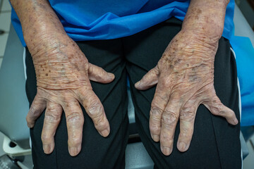 Mature female patient with osteoarthritis