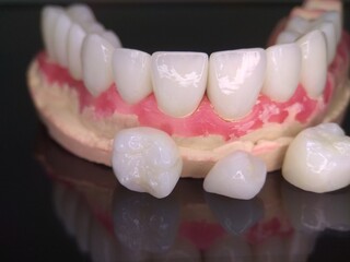 Macro shot of beautiful teeth. Zirconia crowns  on the diagnostic model of the upper jaw against a dark background with reflection