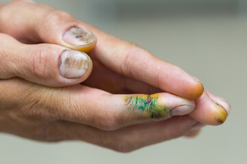 Close-up of a hand cutting man. Dry, cracked skin. Wounds and cracks in the fingers. Skin disease. Lightly injured. Hand skin care. Dermatology and treatment concept