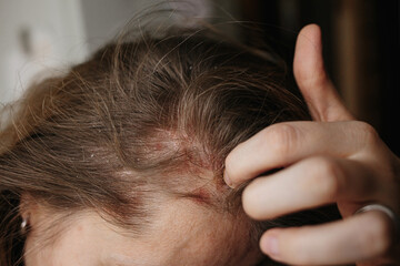 Psoriasis Vulgaris, psoriatic skin disease in head hair, skin patches are typicaly red, itchy, and scaly. Woman furiously scratching her head