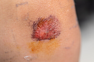 Closeup injured, Fresh wounds from accident. 
