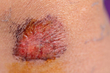 Closeup injured, Fresh wounds from accident. 
