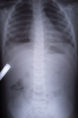X-ray picture of gas in a child. Differential diagnosis of intestinal intussusception in a child