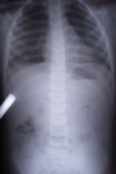 X-ray Picture Of Gas In A Child. Differential Diagnosis Of Intestinal Intussusception In A Child