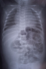intestinal obstruction in a child x ray
