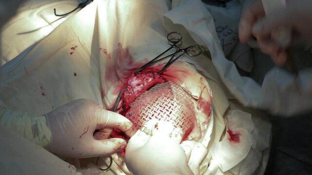 operation on the skull, placing a titanium plate instead of the skull bone in a child after a head injury