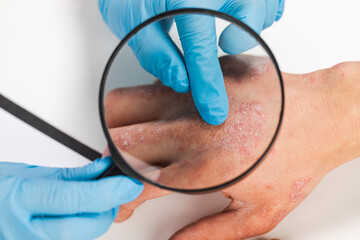 A dermatologist wearing gloves examines the skin of a sick patient. Examination and diagnosis of skin diseases-allergies, psoriasis, eczema, dermatitis