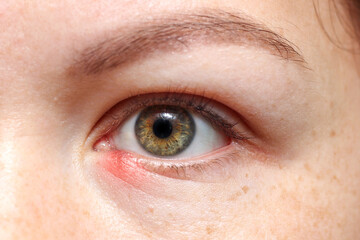 Inflammation, redness in the lower eyelid. Chalazion gordolum. Girl's eye close up.