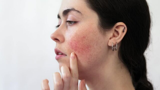 Close-up profile portrait of a young woman showing redness on her cheek. White background. The concept of rosacea and couperose