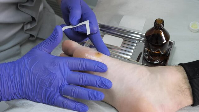 A podiatrist applies a medical patch to a viral wart at a beauty clinic.