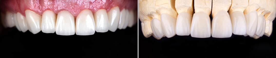 Perfect smile before and after bleaching procedure whitening of zircon arch ceramic prothesis Implants crowns. Dental restoration treatment clinic patient. Result of oral surgery dentistry,