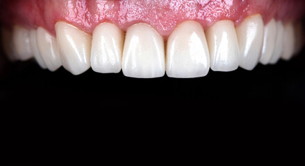 Full mouth teeth made of zircon arch ceramic crowns human teeth of upper veneers of teeth prothesis. Dental restoration treatment clinic patient. Implants on black background closeup surgery dentistry