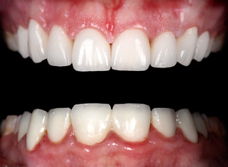 Perfect smile before and after bleaching procedure whitening of zircon arch ceramic prothesis...