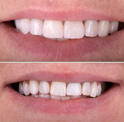 Perfect smile before and after bleaching procedure whitening of zircon arch ceramic prothesis...