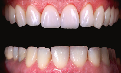 Perfect smile before and after bleaching procedure whitening of zircon arch ceramic prothesis...