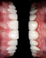 Perfect smile before and after bleaching procedure whitening of zircon arch ceramic prothesis...