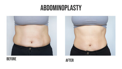 Abdominoplasty, tummy tuck plastic surgery in woman. Front view. Abdominal changes after pregnancy