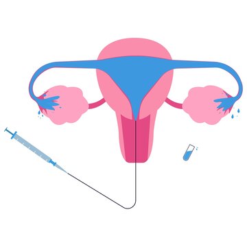 Hysterosalpingogram or HSG, x-ray procedure used to see fallopian tubes and uterus condition. Female reproduction test.