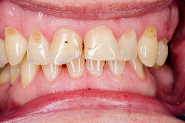 teeth of a person