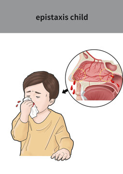 Medical illustration for explanation epistaxis child