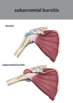 Medical illustration for explanation Subacromial bursitis