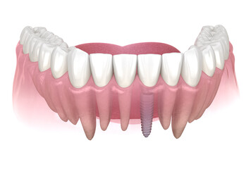 Premolar tooth recovery with implant. Medically accurate 3D illustration of human teeth and dentures concept