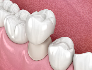 Preparated premolar tooth and dental crown placement. Medically accurate 3D illustration