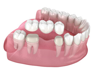 Dental bridge of 3 teeth over molar and premolar. Medically accurate 3D illustration of human teeth treatment - 396974652