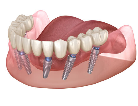 Mandibular prosthesis with gum All on 6 system supported by implants.  Medically accurate 3D illustration of human teeth and dentures concept